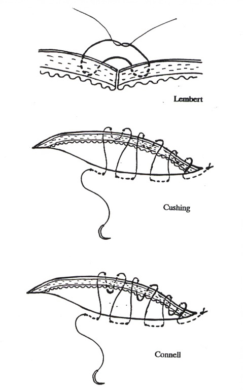 Lembert suture shop